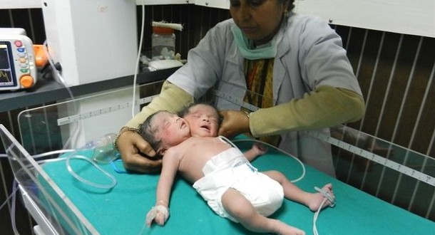 Un bébé à deux têtes voit le jour en Inde