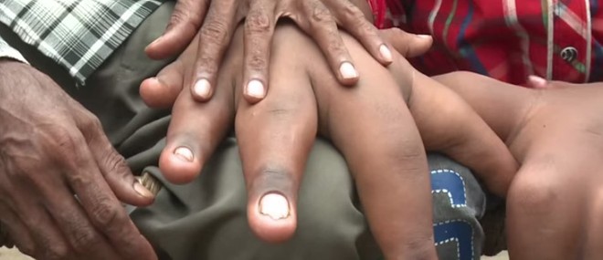 Un jeune Indien de 8 ans avec des mains géantes